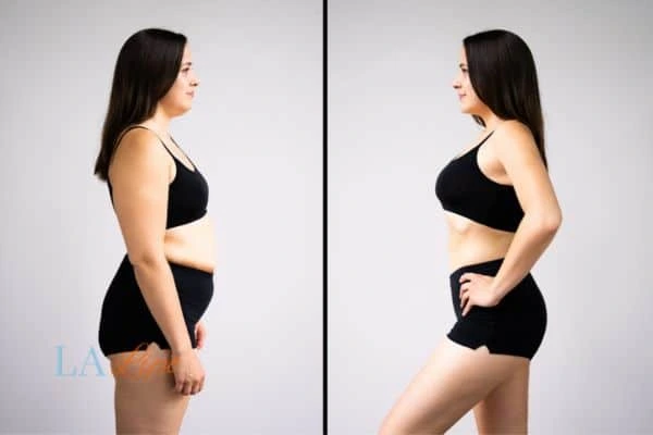 image of woman before and after results of LA-EMS Body Sculpting Rayleigh to help treat Diastasis recti