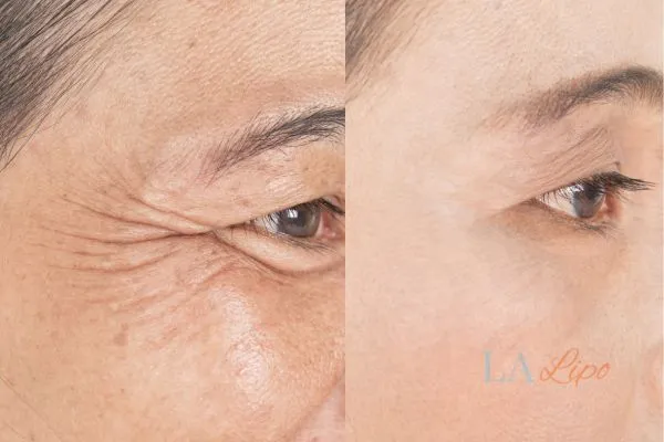 Before and after results of woman - HI-fu wrinkles reduction treatment Rayleigh