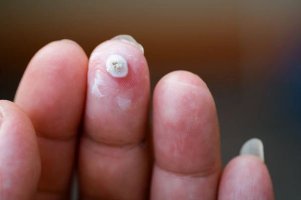 wart on person finger - cryotherapy to treat from LA LIPO Rayleigh