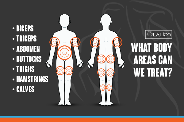 Diagram to show areas you can have LA-EMS Body Sculpting Treatment Rayleigh