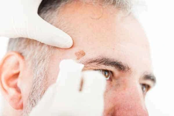 Age spots and elderly people Rayleigh what is the link?