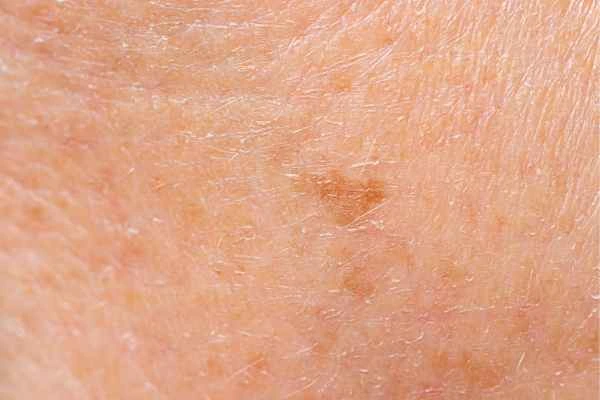 close up picture of age spots Rayleigh